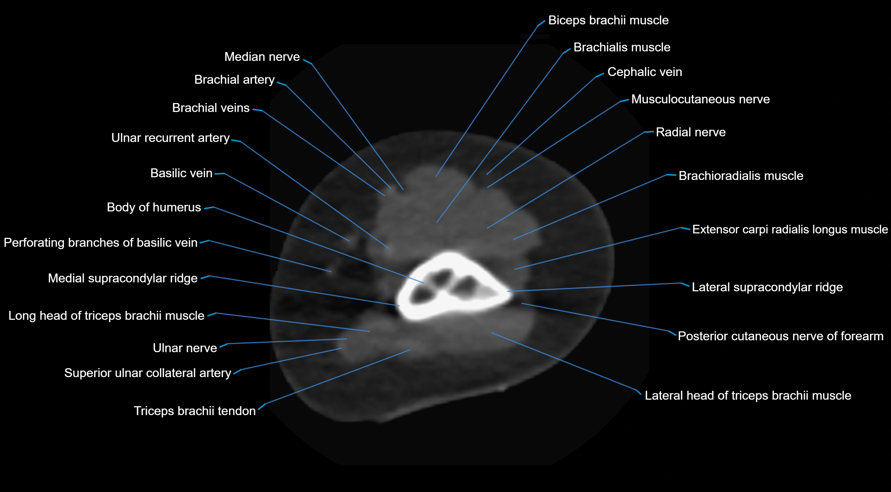 CT elbow axial  cross sectional anatomy labelled  radiology image -00005.webp